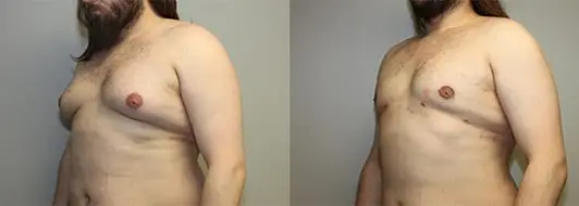 https://capizzimd.com/wp-content/uploads/2018/07/Gynecomastia-2-Front-Facing-Image-OP-GT.jpg