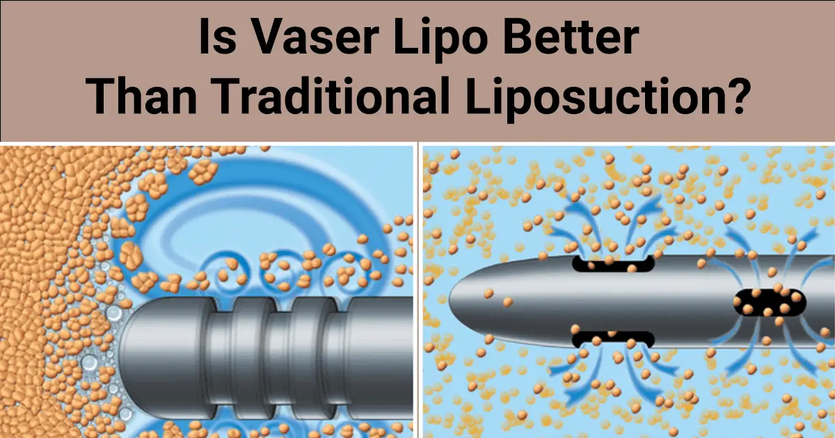 Vaser Lipo breaking up fat cells with ultrasound and traditional Liposuction tip sucking up fat cells.