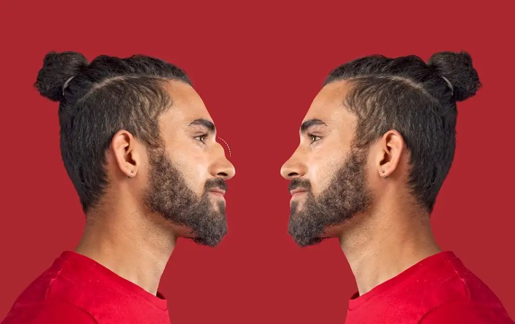 Before and After Comparison of a Man with an Ultrasonic Rhinoplasty