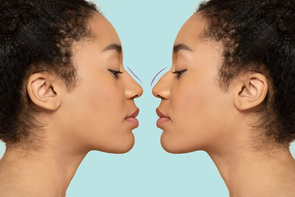 Before and After a Nose Job (Liquid Rhinoplasty) Mirror Image.