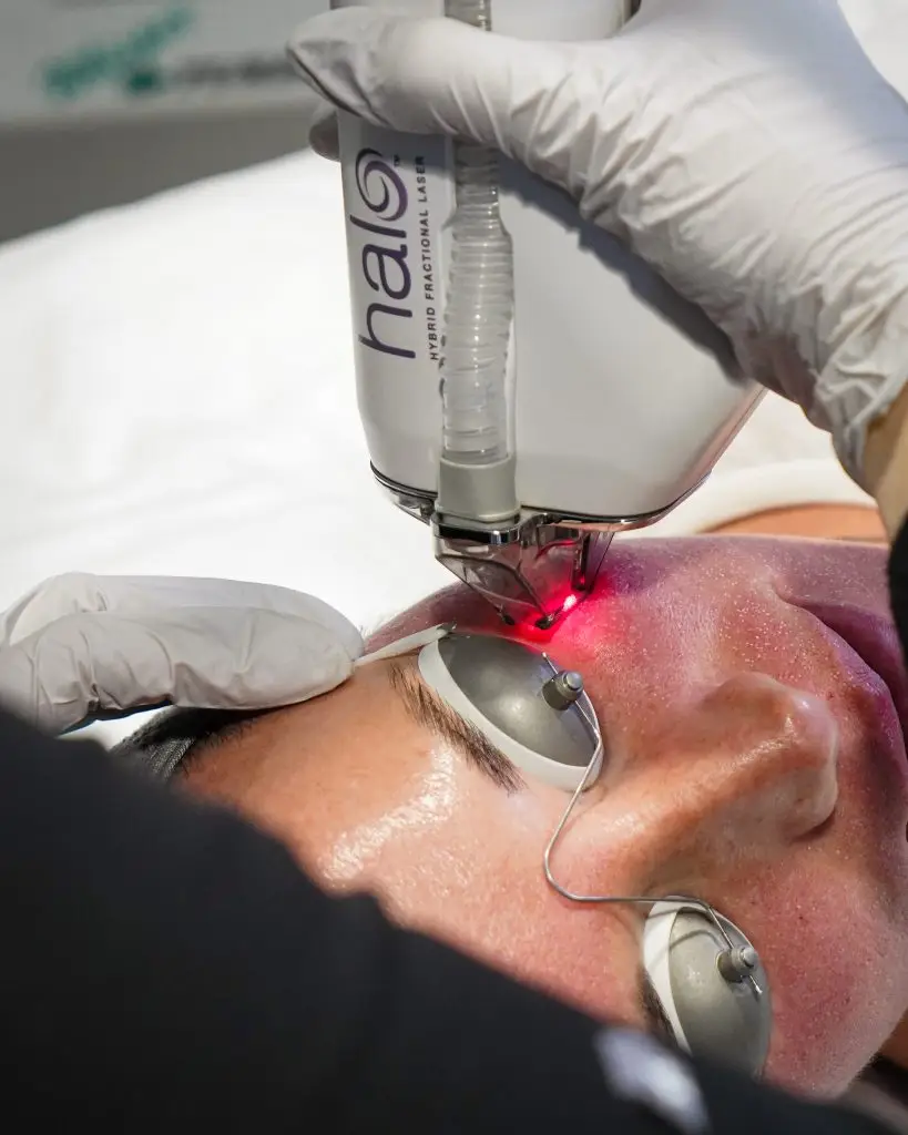 HALO laser skin resurfacing treatment being performed at Capizzi MD to smooth texture, reduce sun damage, and restore youthful glow