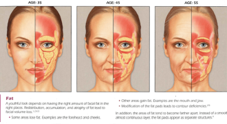 Sculptra