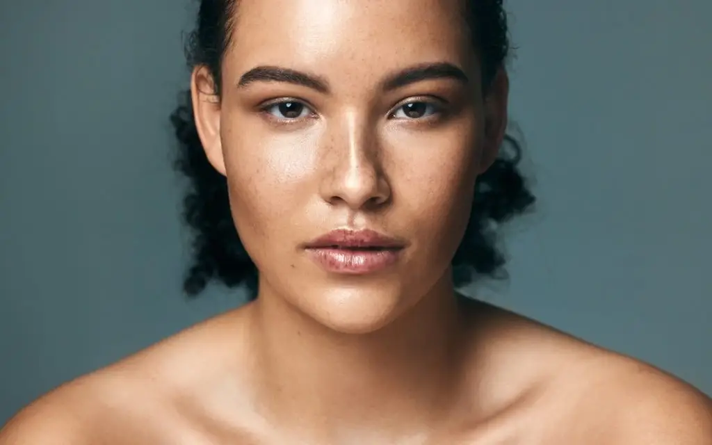 Woman with melasma pigmentation on face